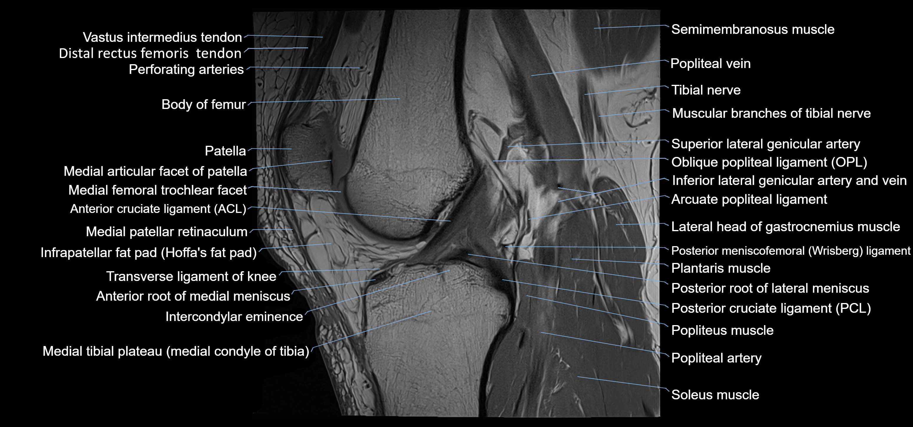 MRI knee sagittal cross sectional anatomy labelled 3T radiology image-00026.webp